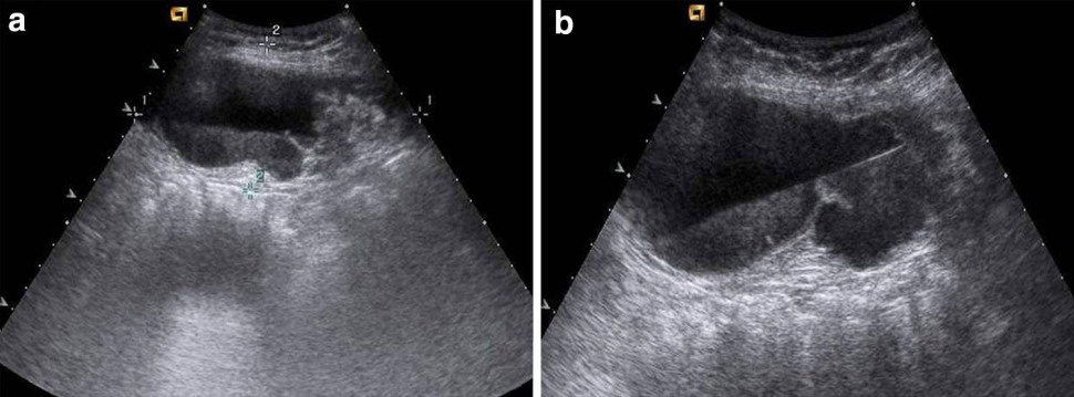 Endovascular management of the rectus muscle hematoma - Interventix